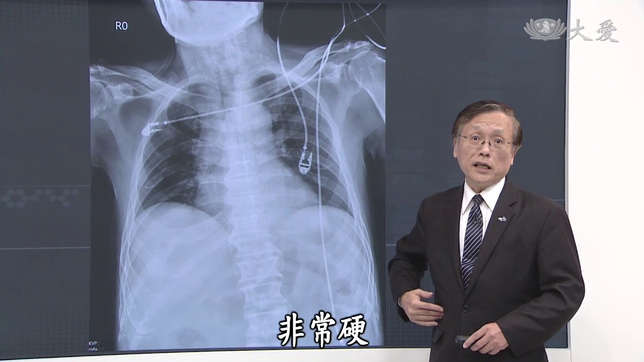 【大愛醫生館】20181119 - 腸胃臭氧層~胃穿孔