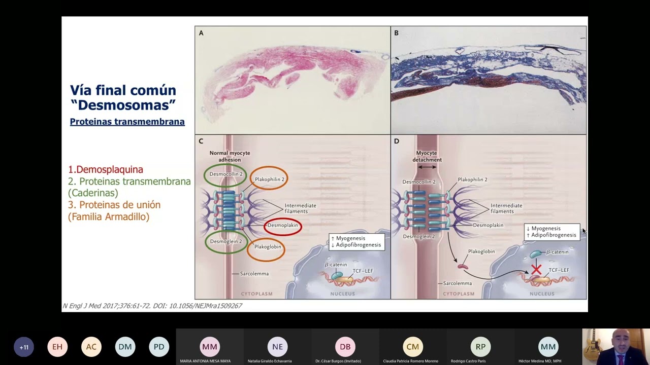 Conferencia Cardiomiopatía Arritmogénica. Una causa de Cardiopatía dilatada y alteraciones del ritmo