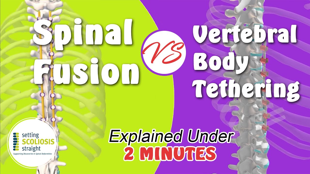 Spinal Fusion vs Vertebral Body Tethering   |   Explained Under 2 Minutes