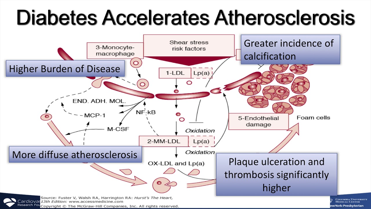 Diabetes and PAD