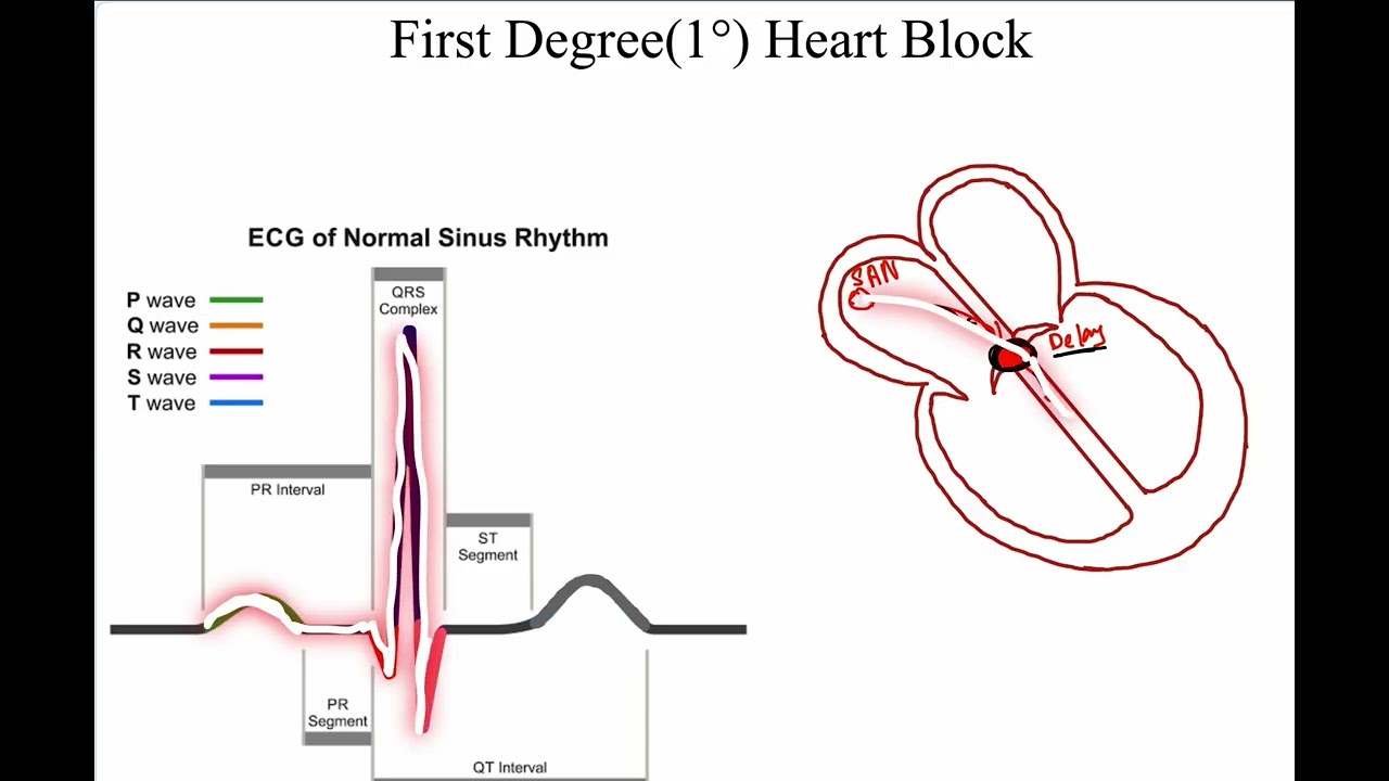 ECG in Bangla: Part 9 (Heart Block)