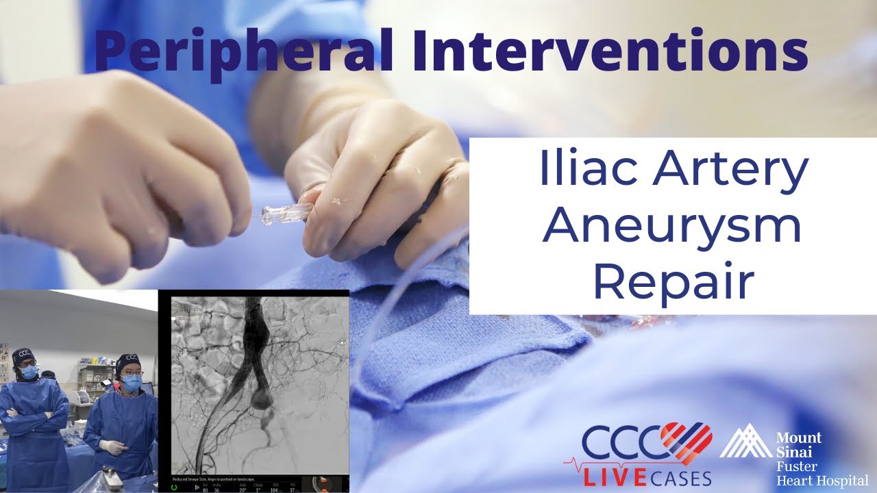 Iliac Artery Aneurysm Repair