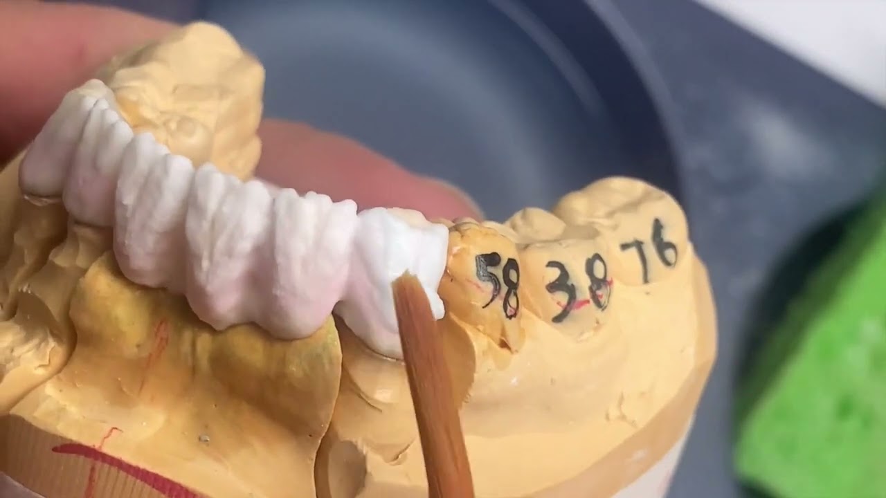 How to Build Lower Front Zirconia Bridge and do Texture on It