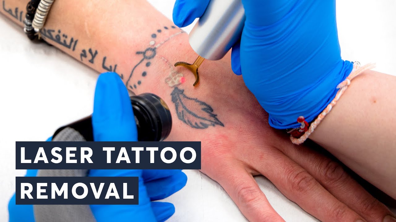 Fast Facts: How Long Does Laser Tattoo Removal Really Take?