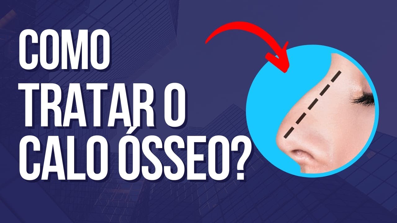 Como tratar o calo ósseo - Rinomodelação definitiva