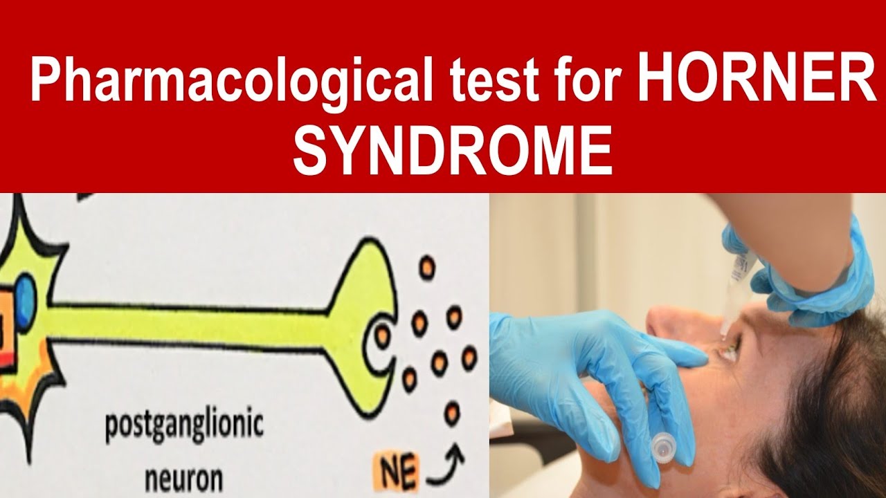 Diagnosis and localising HORNER SYNDROME |cocaine, apraclonidine, hydroxyamphtamine, phenylephrine