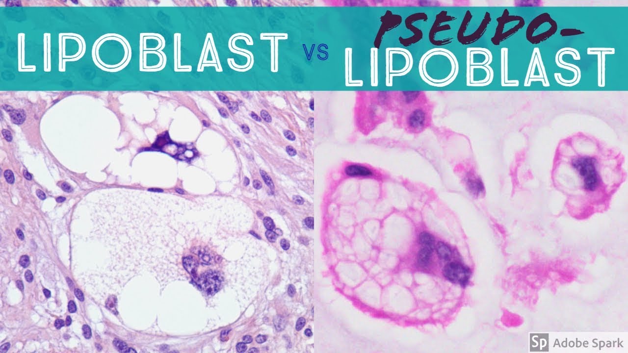 Lipoblast vs PSEUDOlipoblast