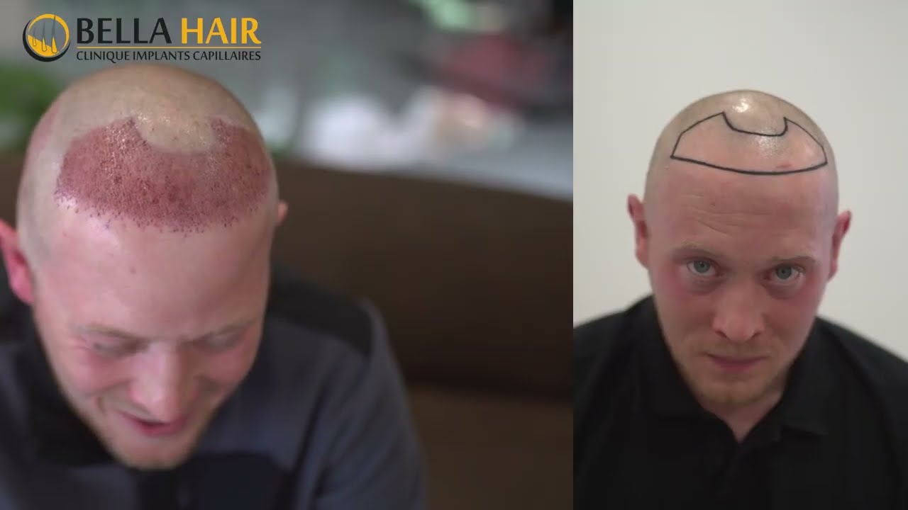 J'ai eu une greffe de cheveux, PRP et laser chez Bellahair. 