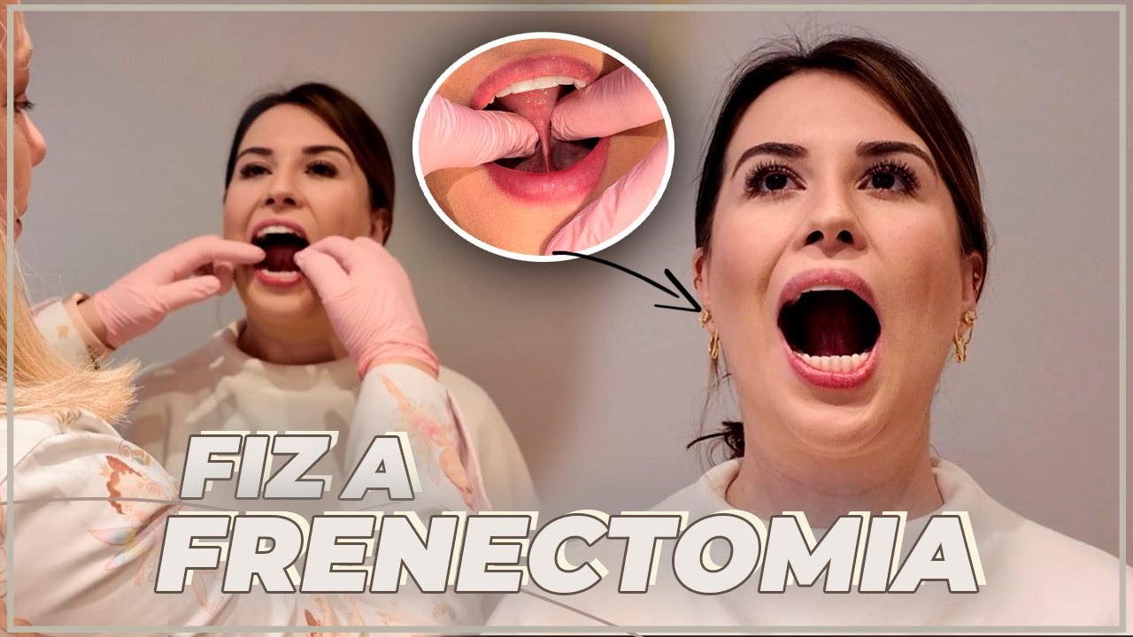 POR QUE FIZ FRENECTOMIA? + ANTES E DEPOIS, RESULTADOS E PÓS OPERATÓRIO