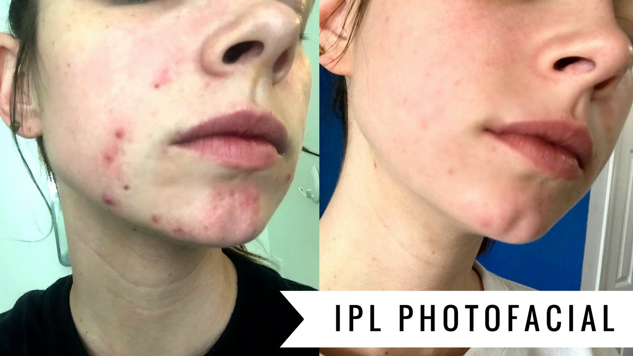 IPL PHOTOFACIAL | Before & After FOUR WEEKS
