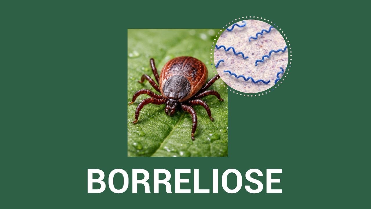Borreliose einfach erklärt - Borrelia burgdorferi, Erythema migrans, Neuroborreliose, PTLDS