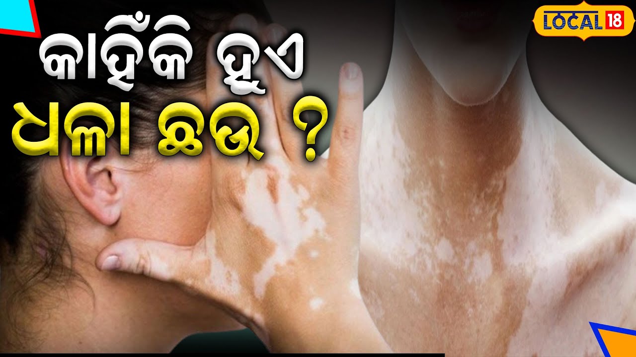 କାହିଁକି ଶରୀରରେ ହୁଏ ଧଳା ଛଉ ଜାଣନ୍ତୁ କାରଣ | Jajpur News | 