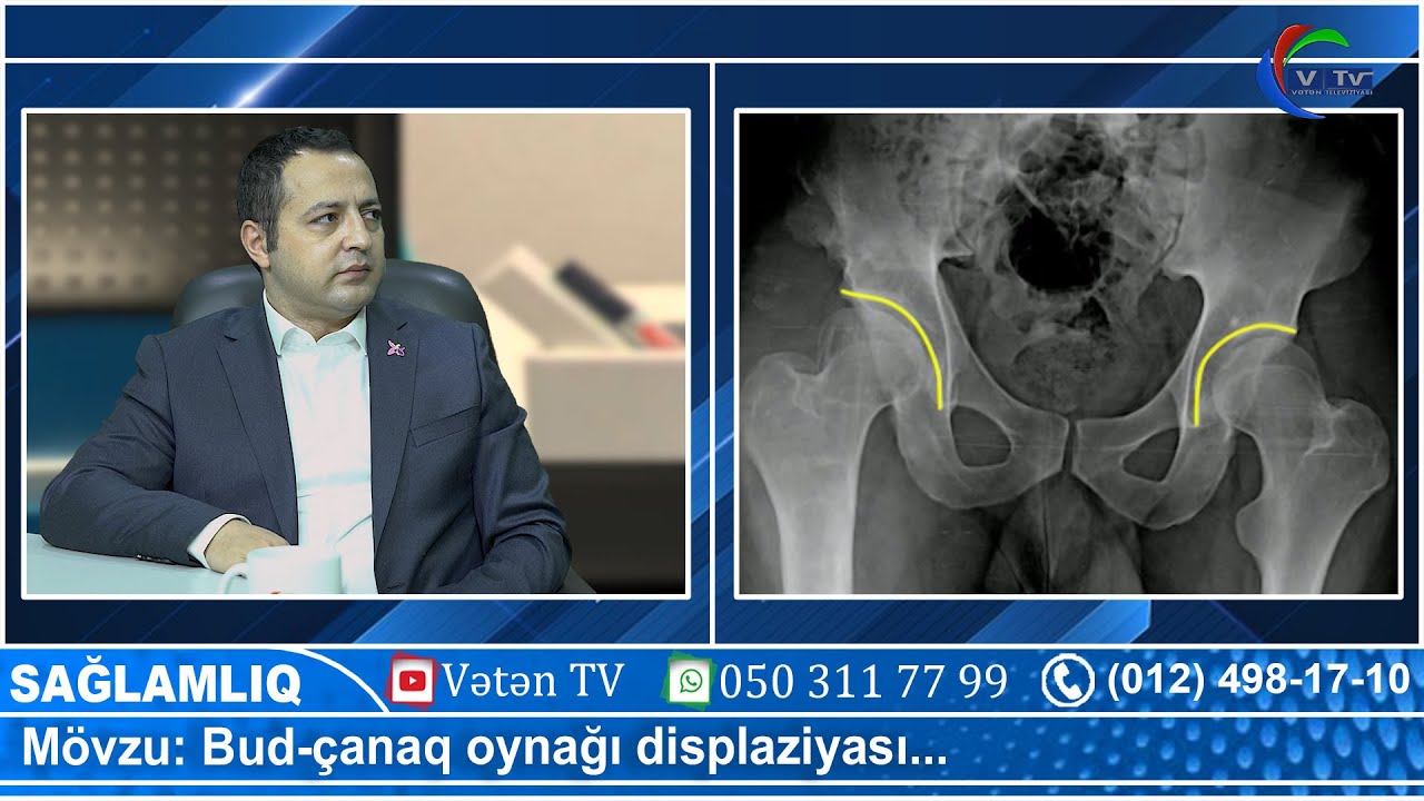 Bud-çanaq oynağı displaziyasının tam müalicəsi varmı?