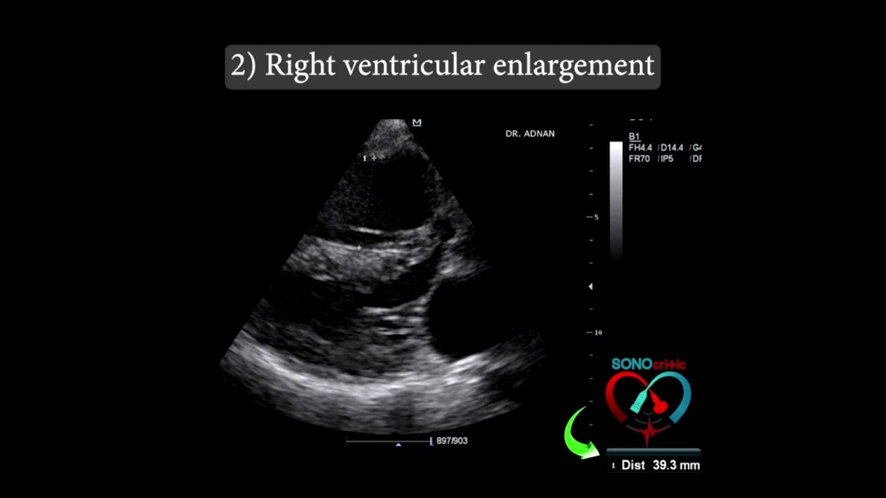 Echocardiographic Findings of Pulmonary Embolism