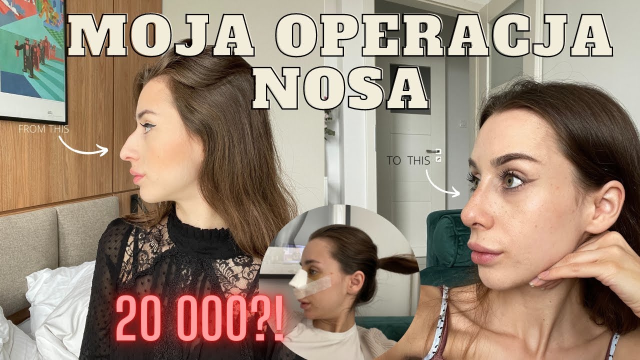 Moja operacja nosa || Ile? || Co zabrać? || Chwile zwątpienia || Moja samoocena po operacji