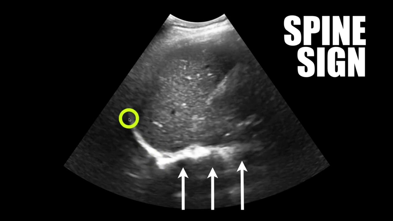Pleural Effusion Part 1 (update!)