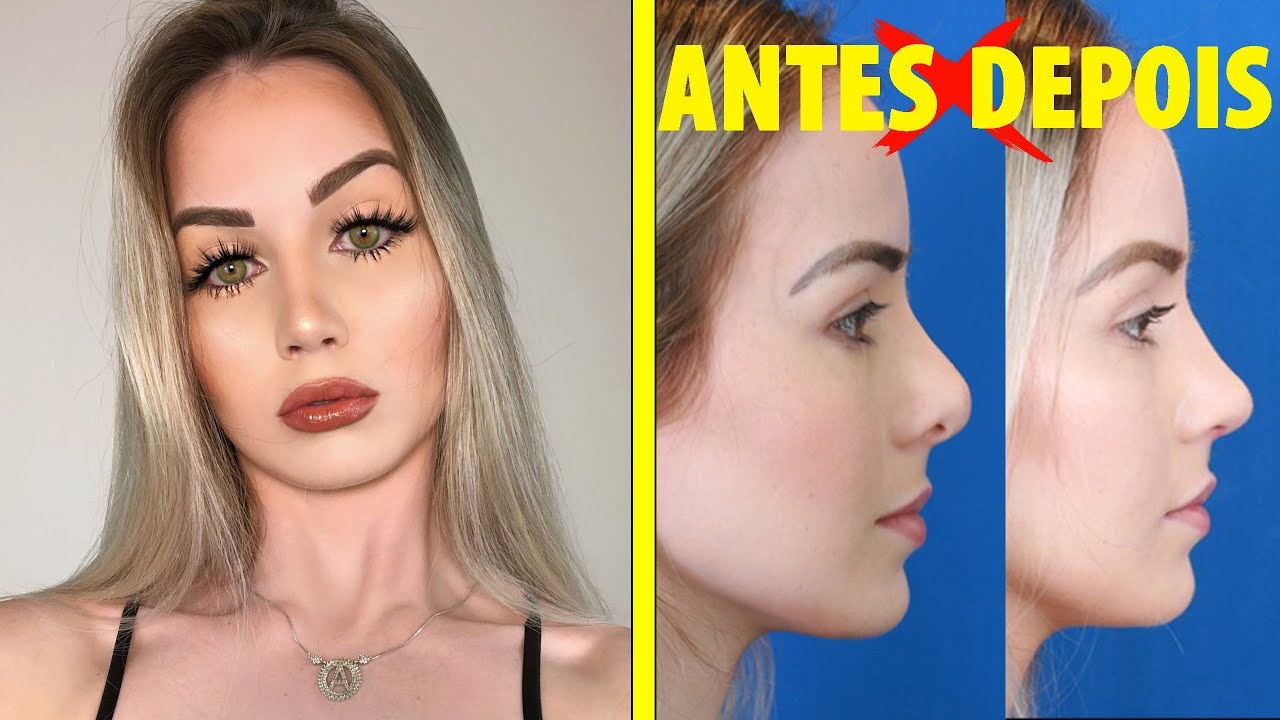 RINOPLASTIA SECUNDÁRIA: VALOR, MÉDICO, DICAS, TUDO!!