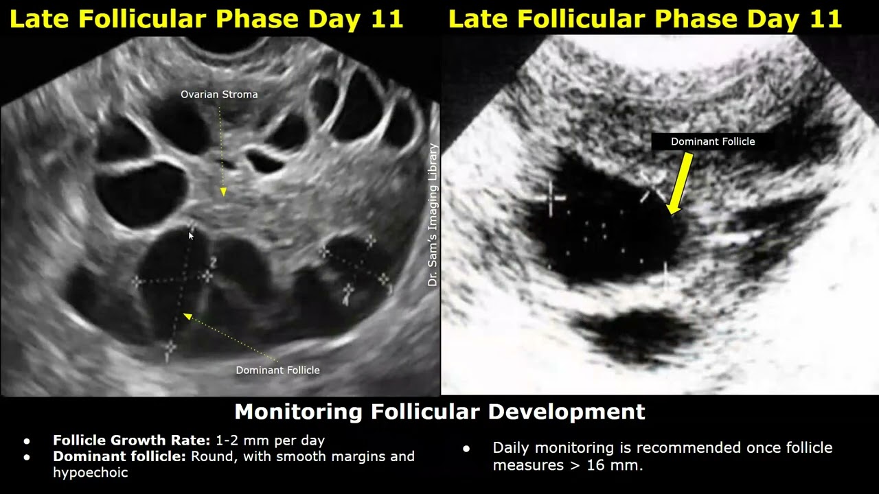 Follicular Monitoring of Ovary on Ultrasound | Ovulation & Fertility Tracking | Gynecological USG