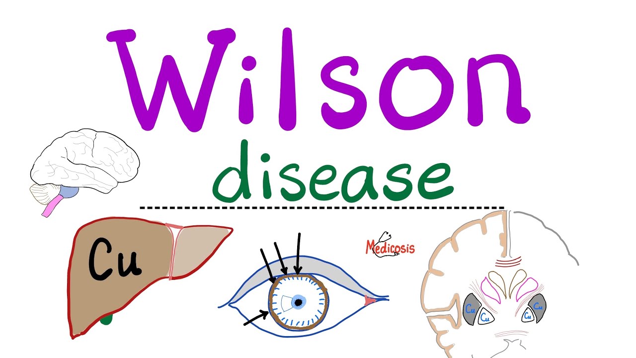 Wilson disease (Hepatolenticular Degeneration)- Copper - Causes, Symptoms, Diagnosis, Treatment