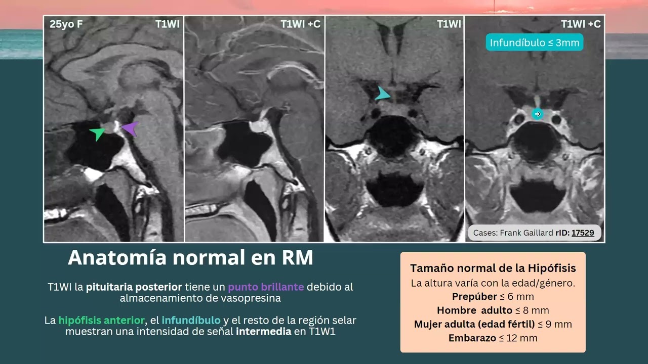 patología de la región selar