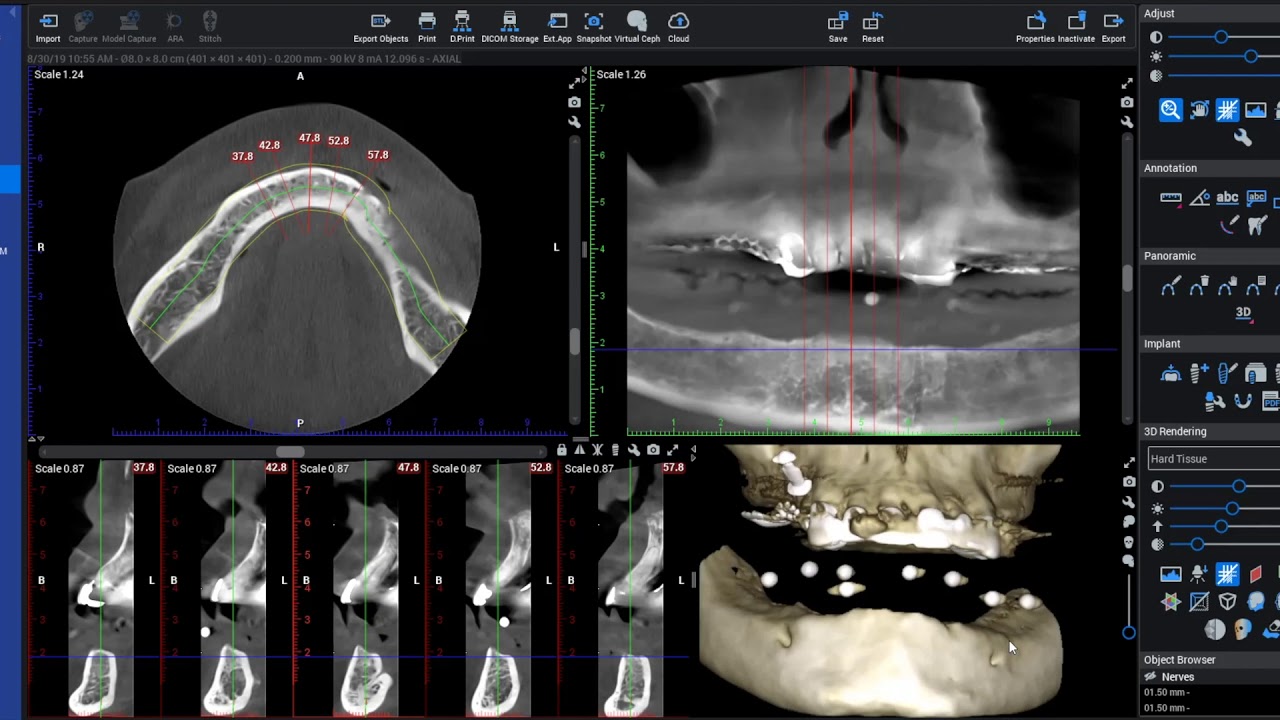 Denture Dual Scan Planmeca Romexis