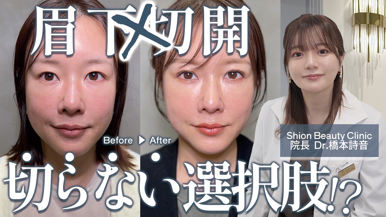 “切る前”に知って欲しい！【眉下切開をしない判断】