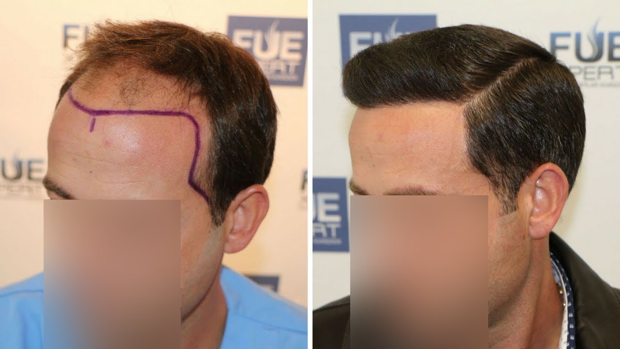 Injerto Capilar FUE (3958 injertos - Alopecia NW IV-A) Dr. Couto - FUEXPERT CLINIC - Recuperar Pelo