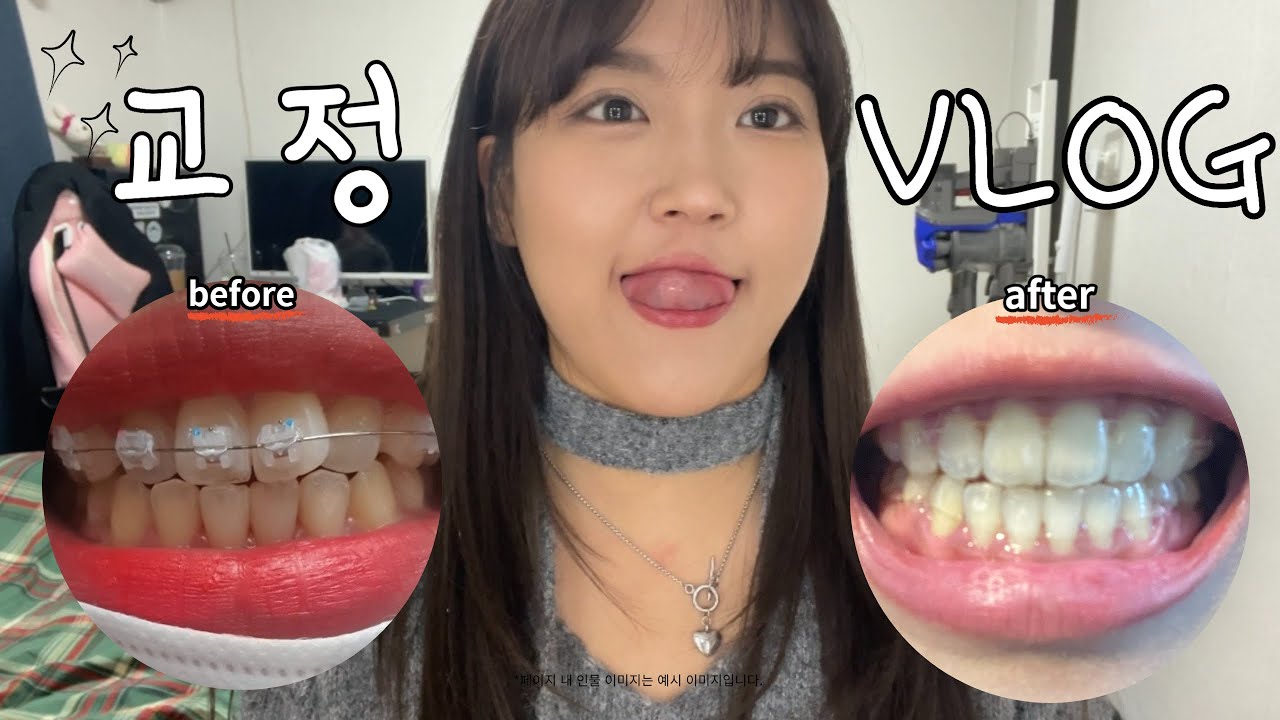 [VLOG DAILY] 교정인 탈출 👄 l 교정 후기ㅣ토끼앞니 교정ㅣ교정하기 전 드리고 싶은 말..🦷ㅣ교정부작용