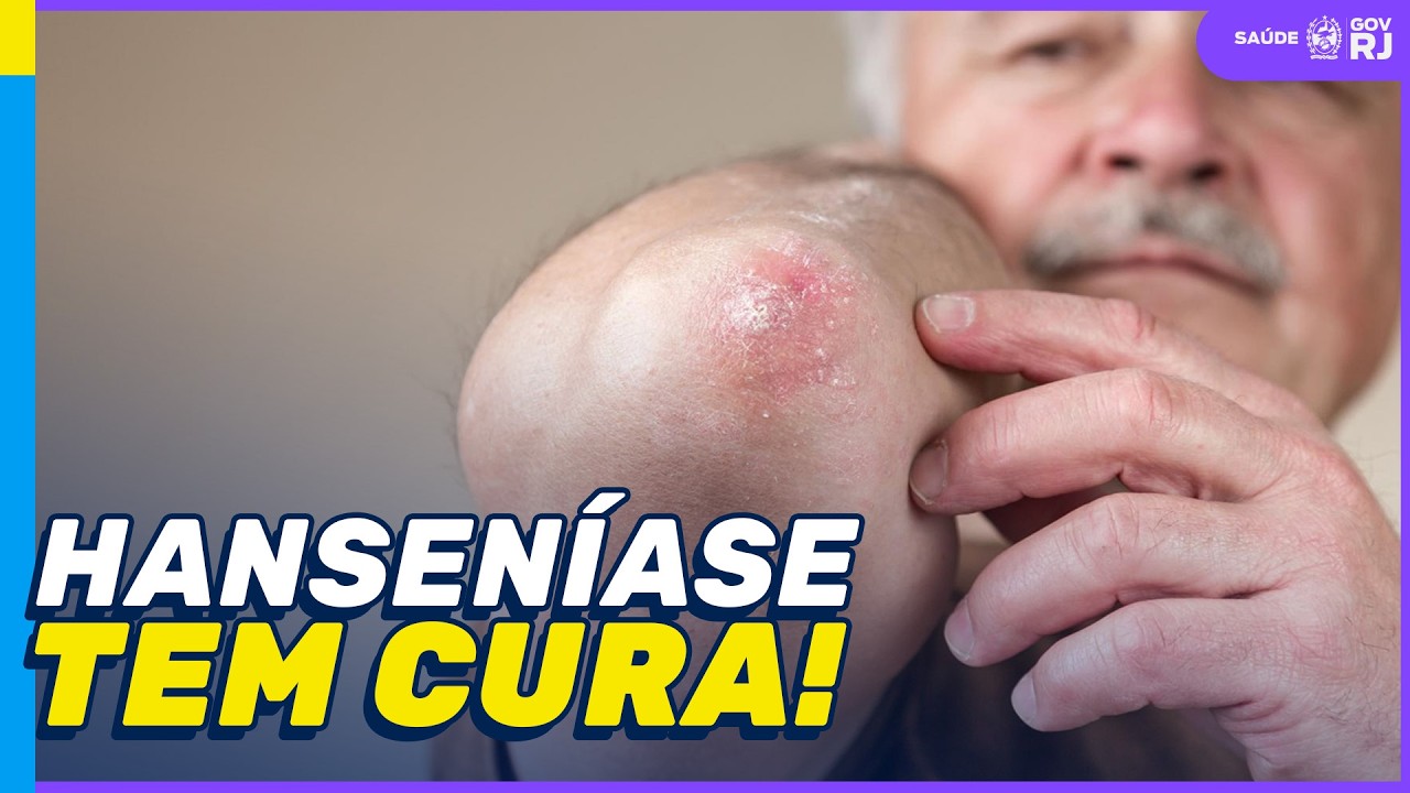 Hanseníase: diagnóstico precoce muda vidas no Rio de Janeiro