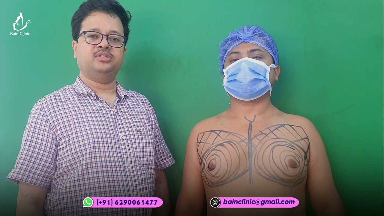 Gynecomastia Marking || cause of gynecomastia || Dr. Jayanta Bain plastic surgeon
