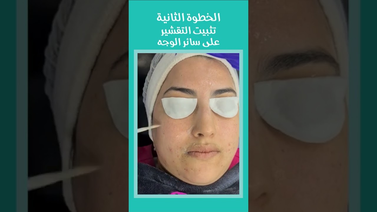 حلقة اليوم مع الدكتورة كوثر مستعد : كيفية علاج حب الشباب دون أخد أدوية