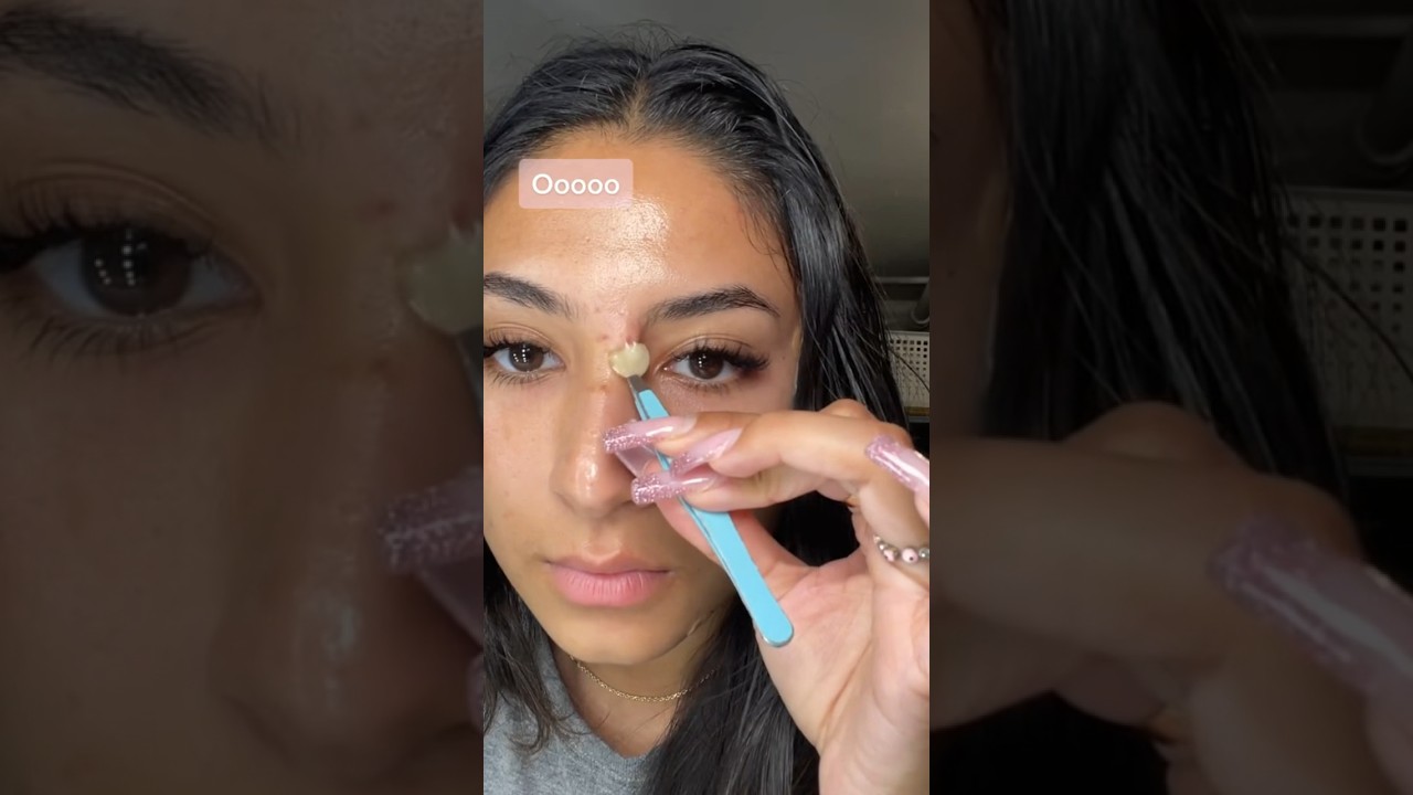 👀Let&rsquo;s peel off these pimple patches! 🙌 #pimplesolution #pimplepatch #acne #pimples