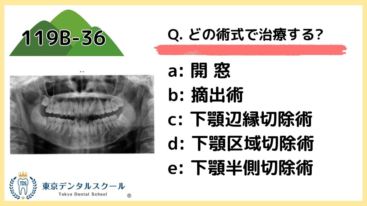 国試で絶対落とせない！下顎病変の術式選択 完全整理　119B36