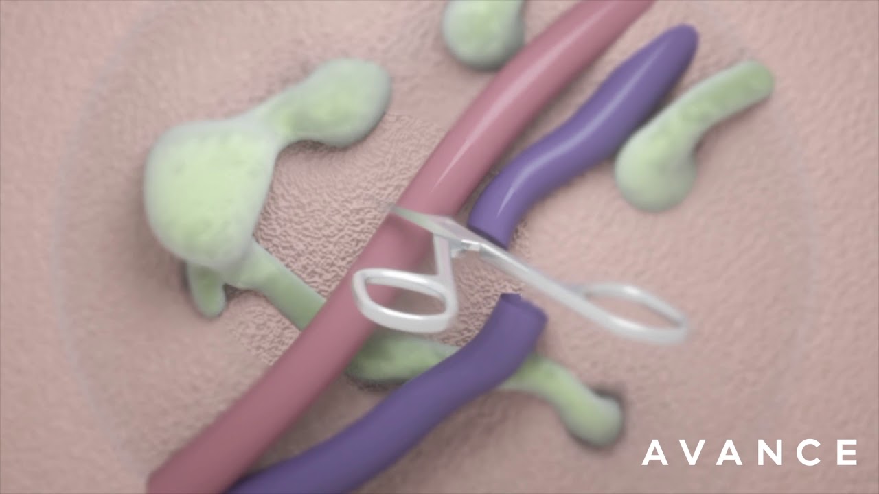Lymph node Transfer Dr. Erez Dayan Avance Plastic Surgery