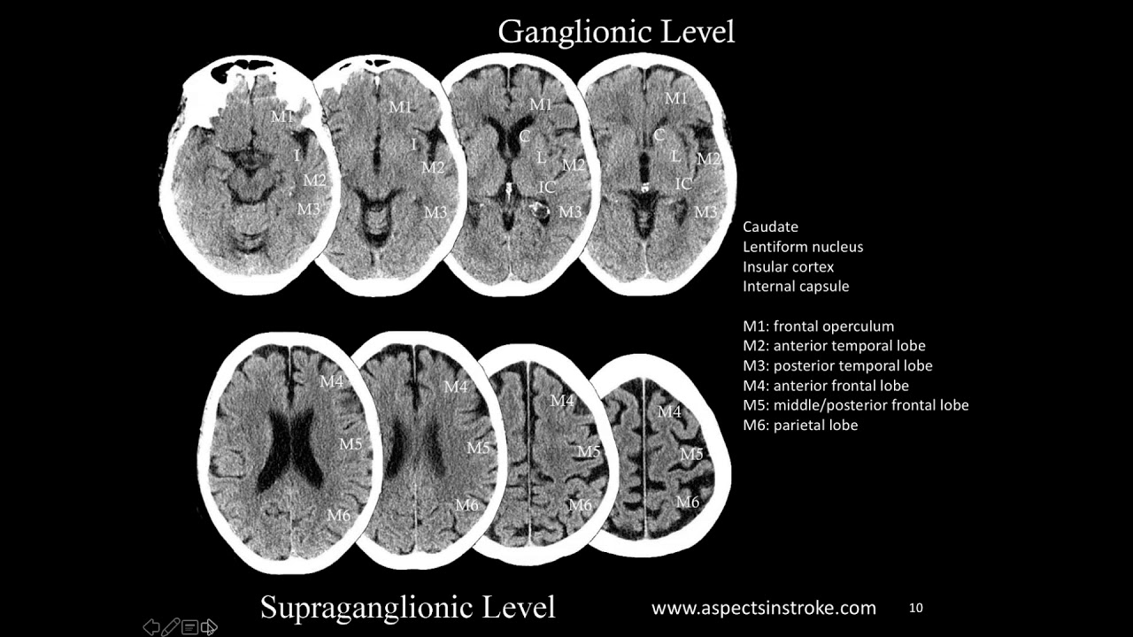 SIR-RFS Webinar (6/5/2018): Updates on Endovascular Therapy for Acute Ischemic Stroke
