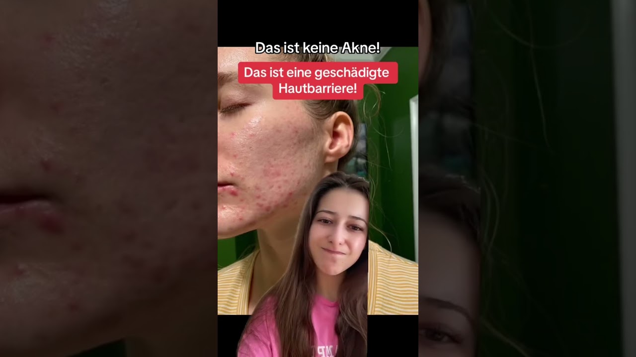 Geschädigte Hautbarriere erkennen: Keine Pickel !🛡️✨ 