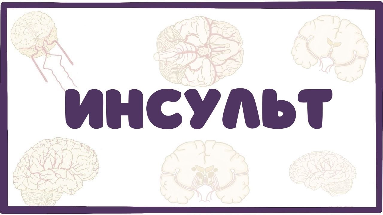 Инсульт - причины, симптомы, лечение (неврология лекция)
