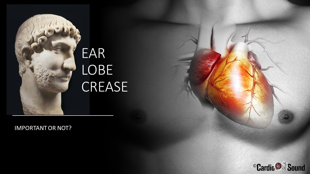 Ear Lobe Crease: What does it mean?