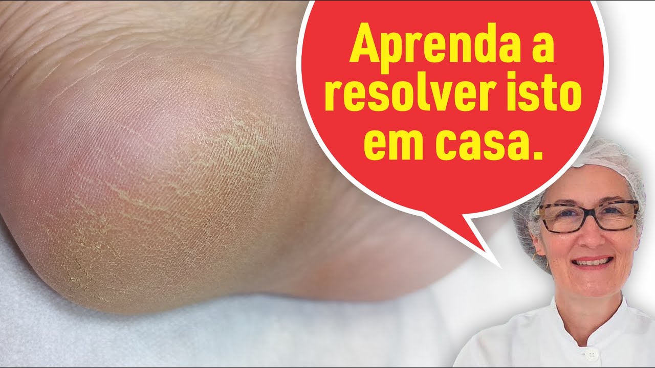 CALCANHAR RESSECADO RESOLVA EM CASA