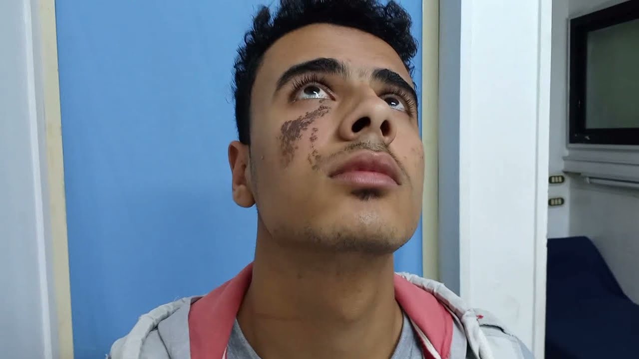 ازالة الوحمه الصبغيه الدهنيه باستخدام التبريد الكاربوكسى ا د نادر المليجى