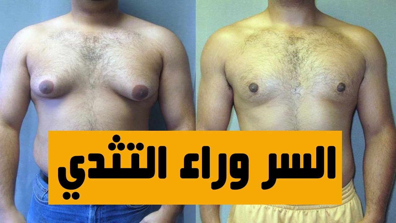 التثدي عند الرجال انواعه واسبابه وطرق علاجه/كيف اتخلص من التثدي/علاج ترهل الثدي عند الرجال