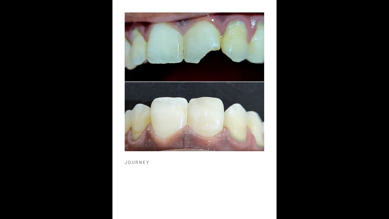 Recreate Broken Front Tooth - Restore Smile Again !