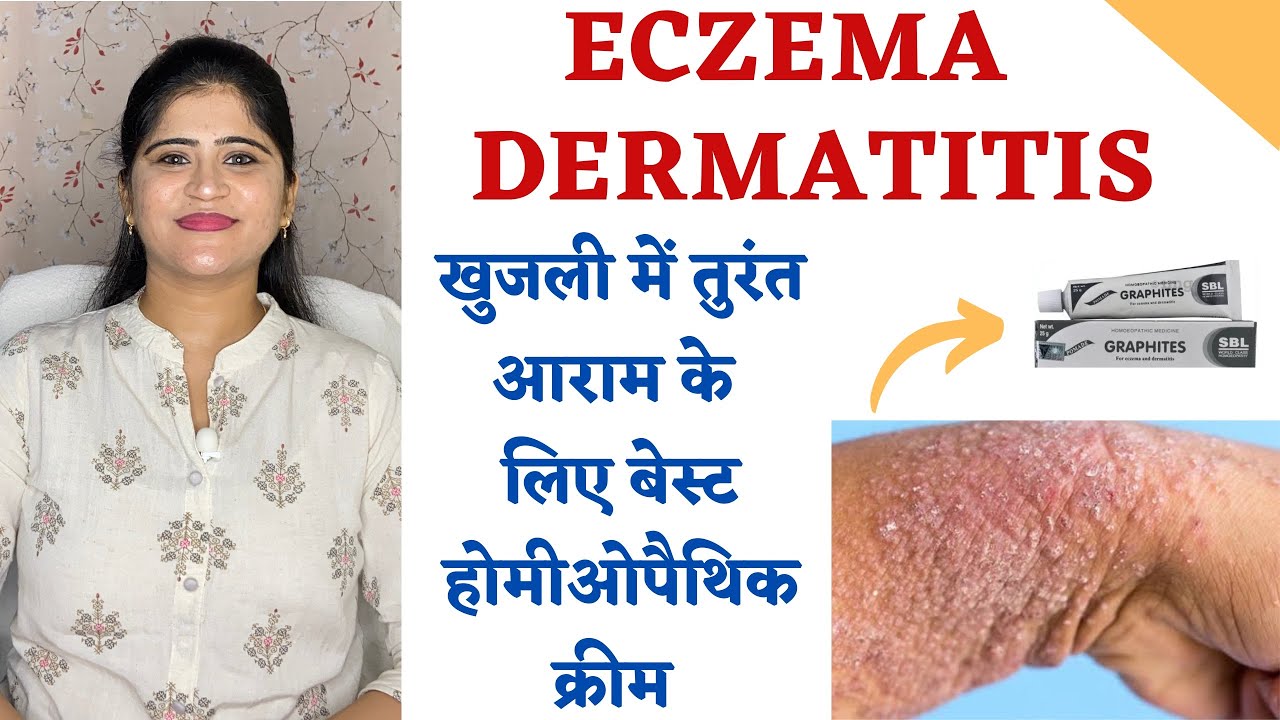 Best Homeopathic cream for Eczema and Dematitis ॥ खुजली में तुरंत आराम (Gives instant Relief)