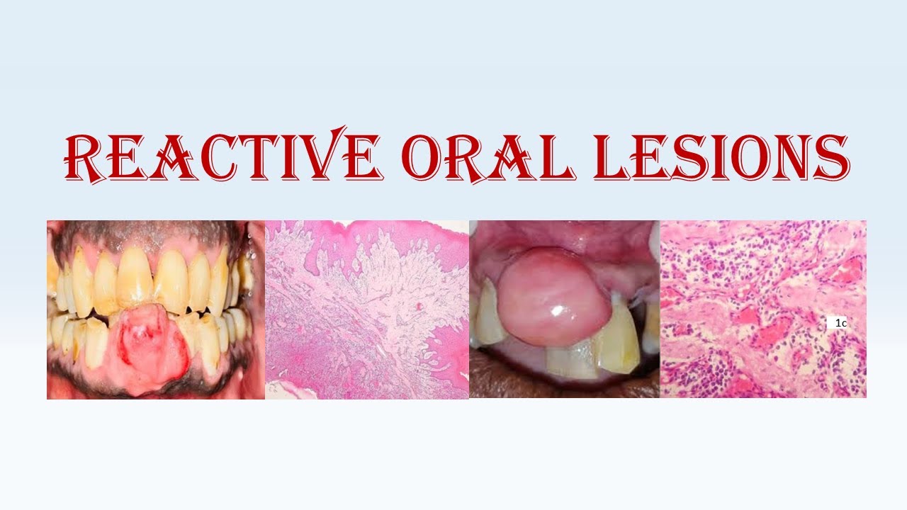 Oral Pathology 2 - Reactive Oral Lesions