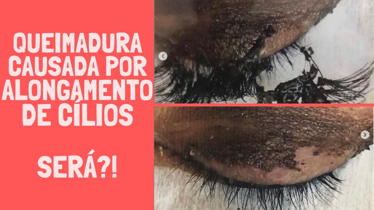 Queimadura causada por alongamento de cílios fio a fio, híbrido ou volume russo... Será mesmo?