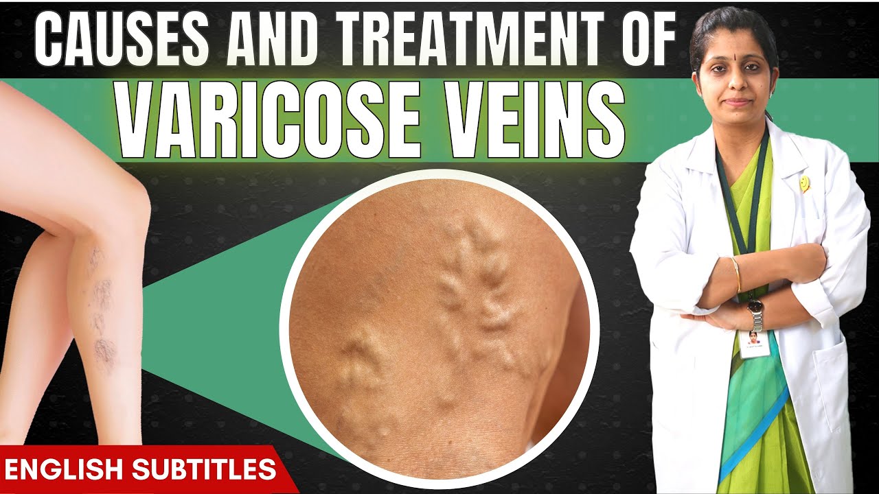 ⚠️Alert: Don't Ignore Varicose Veins | வெரிகோஸ் வெய்ன்ஸை அலட்சியமாக நினைக்காதீர்கள்!!