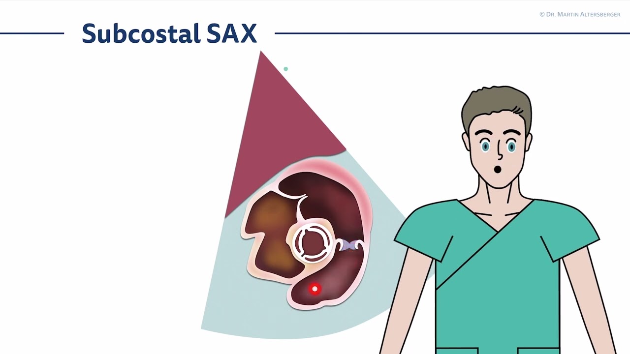 〖Echocardiography〗 Subcostal views - full version🫀