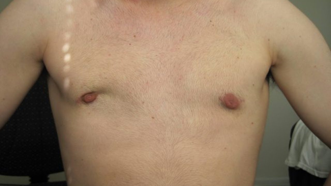 Why We Should Never Cut 100% Gland In gynecomastia Surgery