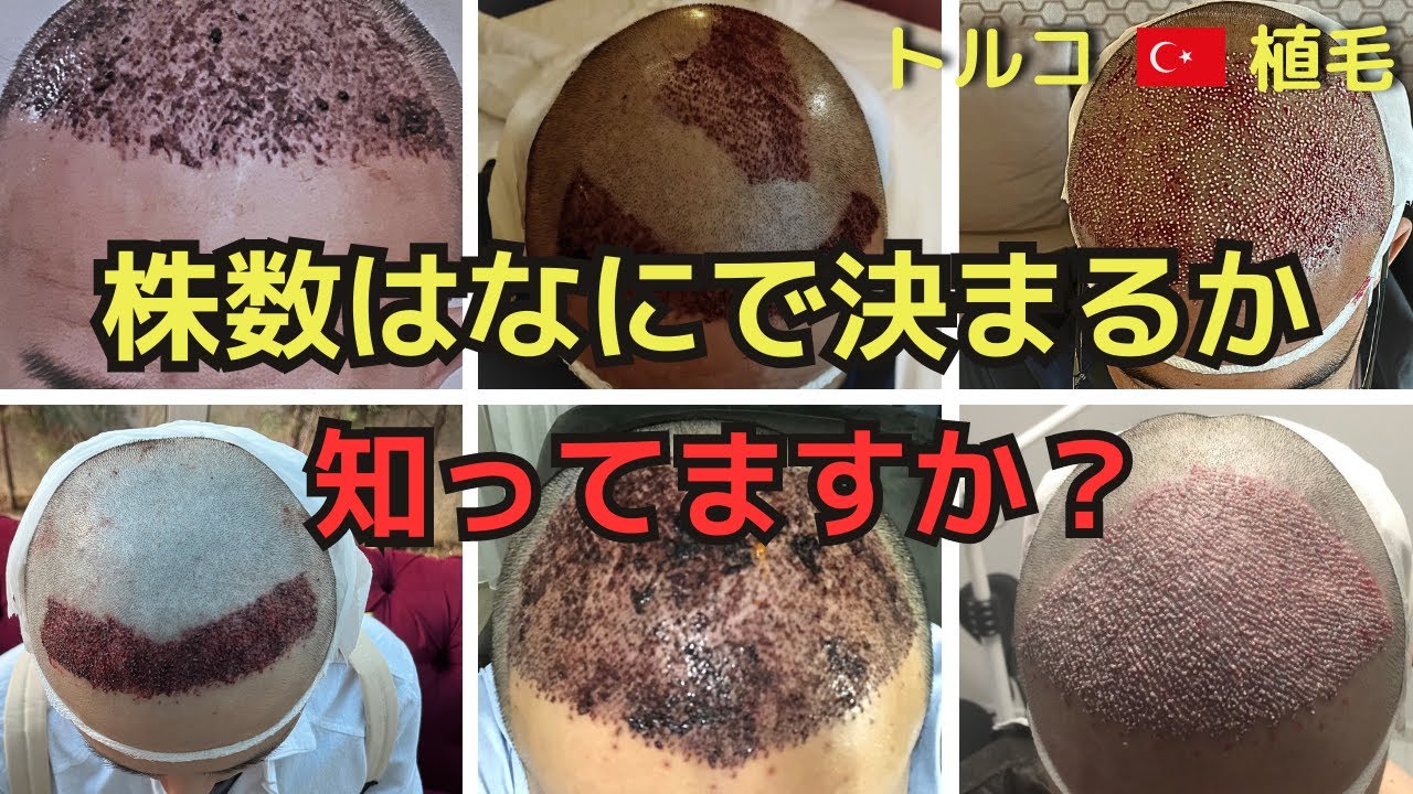 【衝撃の事実】実はトルコ植毛は植え放題ではないです...（株数と密度について）【６例解説/トルコ植毛/70万】