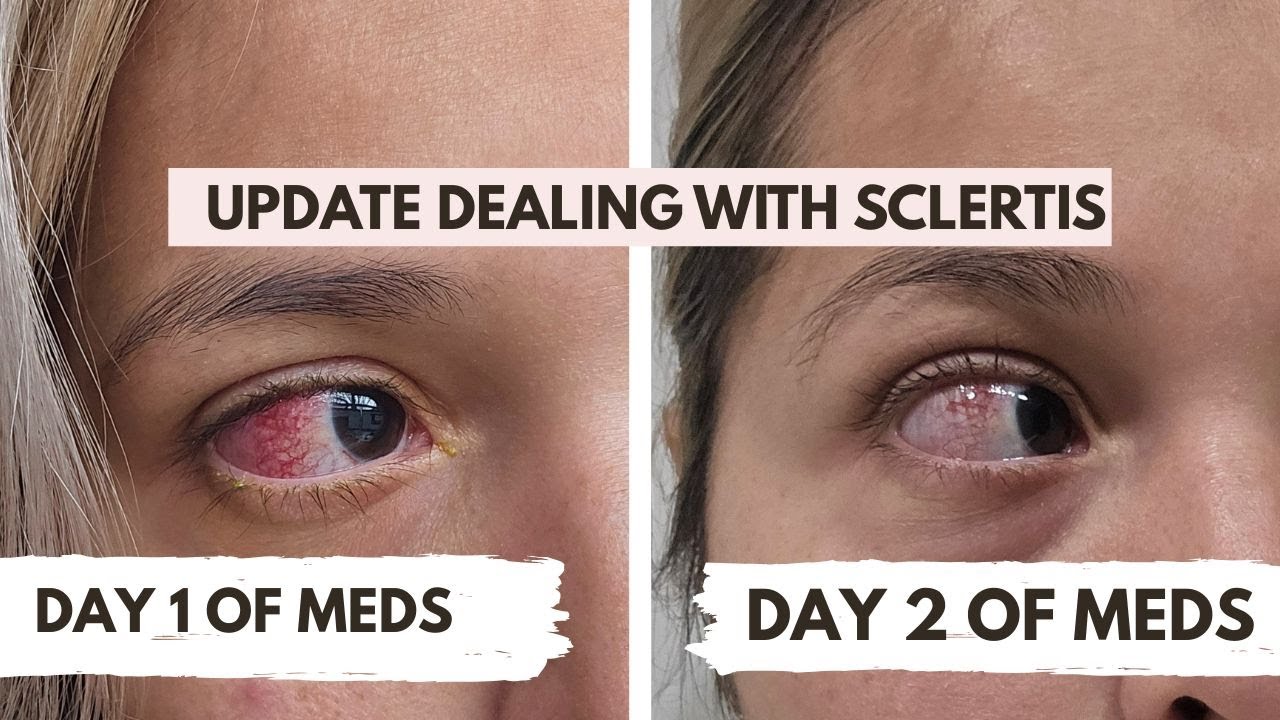 Update on Dealing with Scleritis!  My Scleritis Journey!